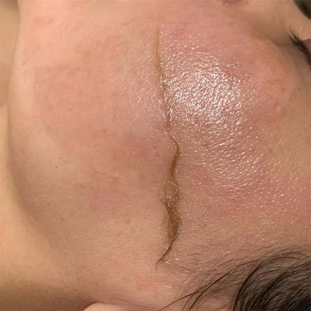 Dermaplaning vs Face Shaving: What’s the Difference?