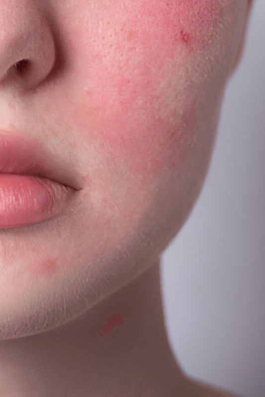 Common Dermaplaning Mistakes That Cause Irritation